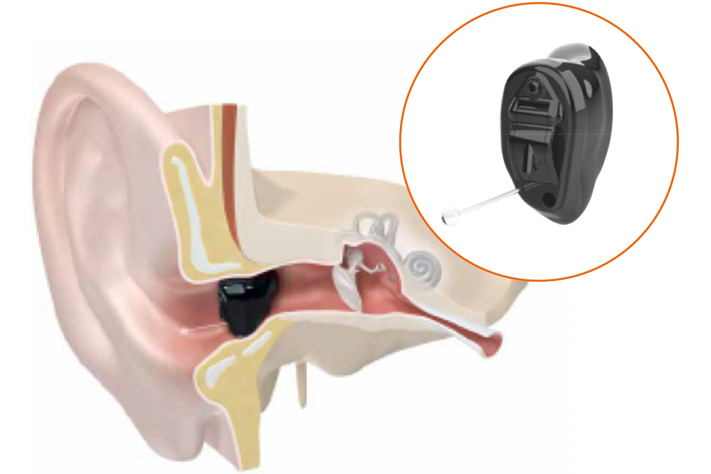 unsichtbares Hörgerät, im Ohr verstecktes Hörgerät, klein und unkompliziert